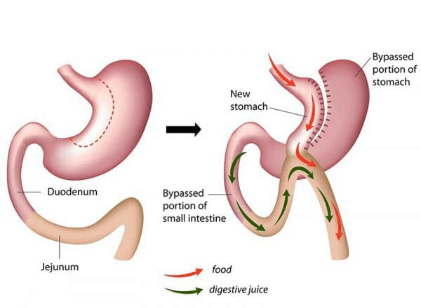 mini gastric bypass
