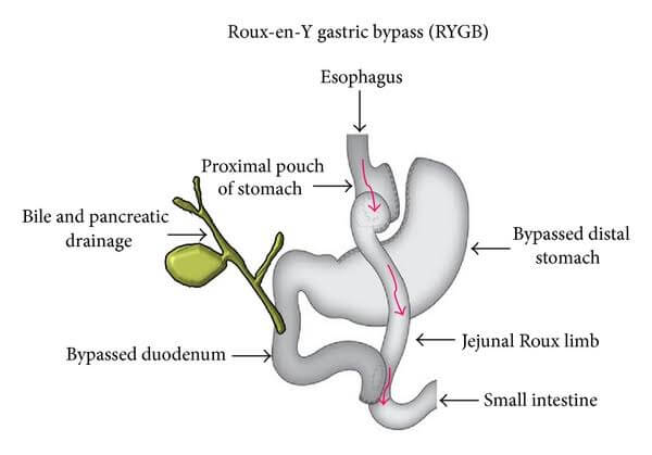 Gastric Bypass in anemia Sufferers Following The Explanation Image Gastric Bypass in anemia Sufferers Following The Explanation