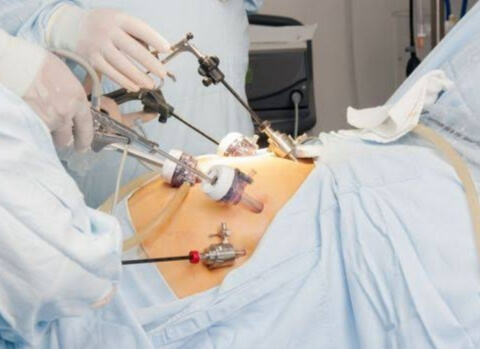 Image Get to know Sleeve Gastrectomy An Effective Weight Loss Surgical Procedure