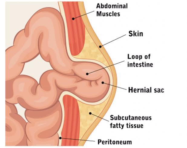 Image Abdominal Hernia: Causes, Symptoms, and Treatment In Perth