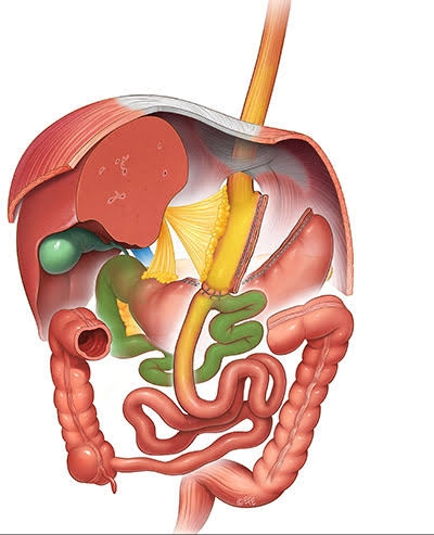 Anastomosis Gastric Bypass Surgery: A Comprehensive Guide Image Anastomosis Gastric Bypass Surgery: A Comprehensive Guide