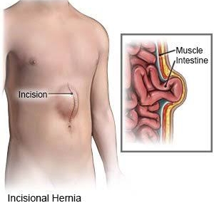 Image Incisional Hernia: Causes, Symptoms, and Treatment