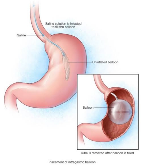 Image Intra Gastric Balloon A Comprehensive Guide to a Non-Surgical Weight Loss Solution
