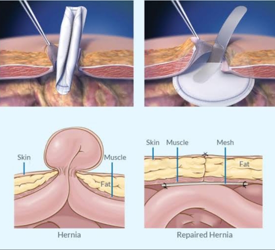 Image Mesh Repair for Hernia