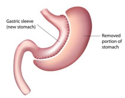 Image Understanding the Pain Level of Gastric Sleeve Surgery