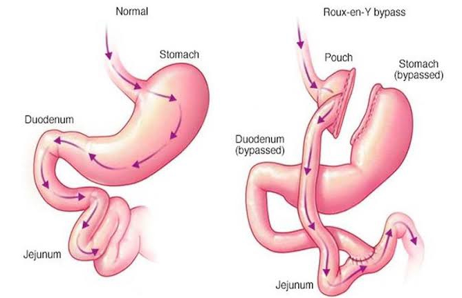 Understanding Roux Y Gastric Bypass Image Understanding Roux Y Gastric Bypass