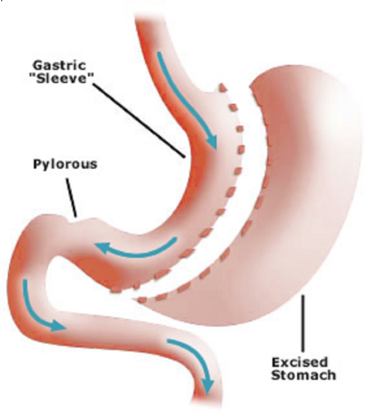 Image Sleeve Gastrectomy A Comprehensive Overview