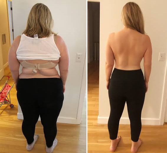 Image What is the safest weight loss surgery?