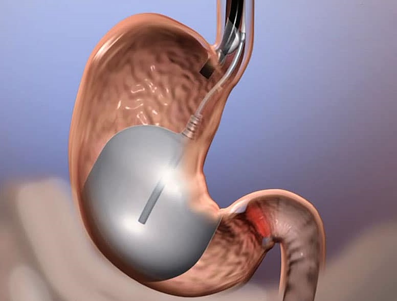 Image The Benefits of Gastric Balloon for Weight Loss