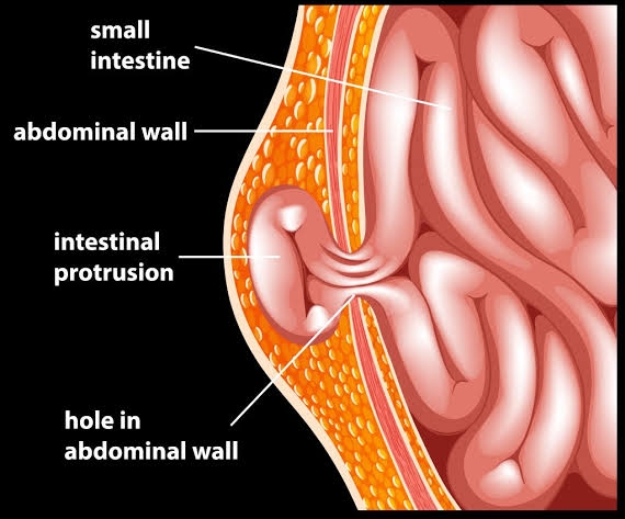 Image How to Prevent Hernia