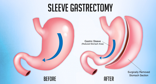 Sleeve Gastrectomy Procedure