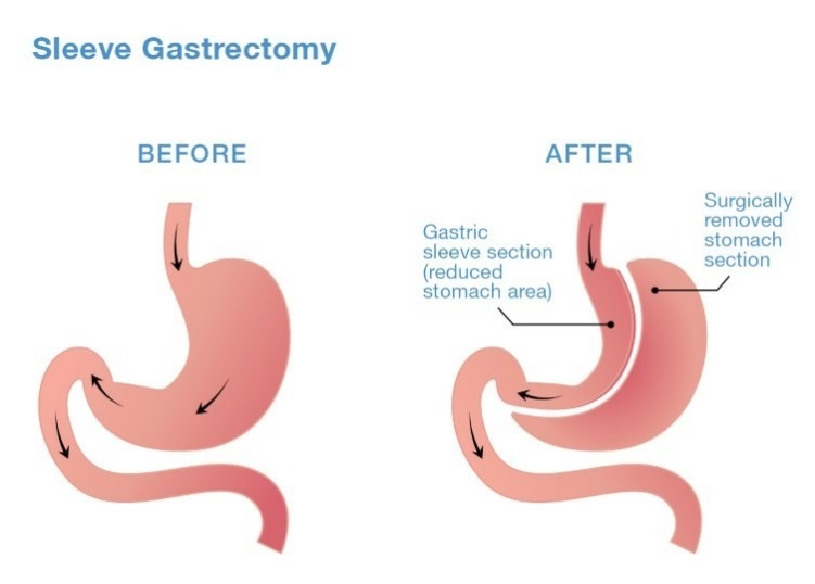 Image The Benefits of Sleeve Gastrectomy for Weight Loss In Perth