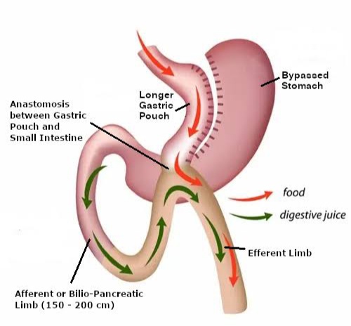 Image Exploring Various Gastric Bypass