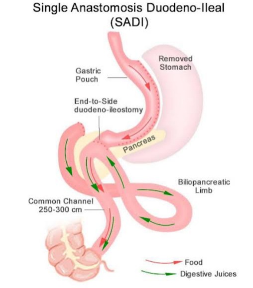 Image Sadi Sips Gastric Bypass Treatment