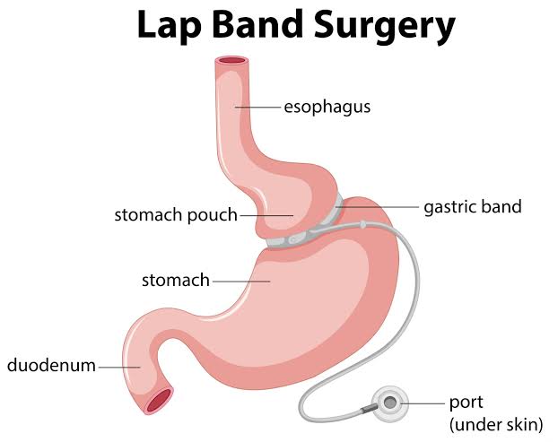 images Lap Band Surgery