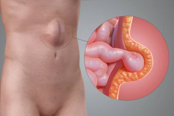 Image Tips Regarding Incisional Hernia