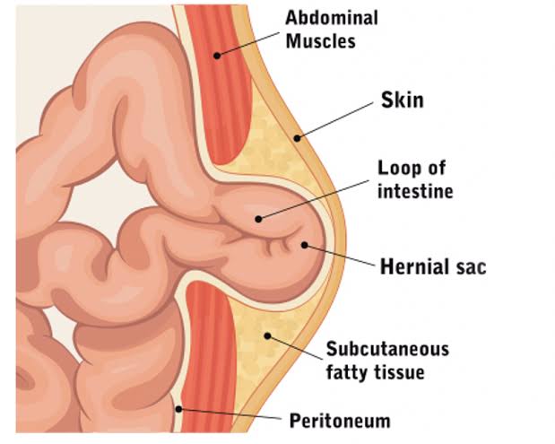 Image Managing Hernia Effective Treatment Approaches