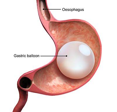 images Gastric Balloon Insertion