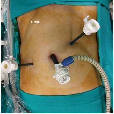 Laparoscopic Hernia Repair in Women Image Laparoscopic Hernia Repair in Women
