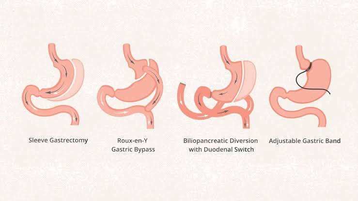 Image Sleeve Gastrectomy