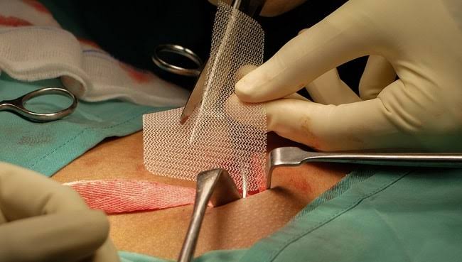 Image Tips Before Mesh Repair for Hernia