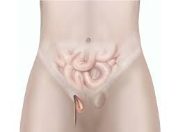 Image Several Factors Causing Hernia