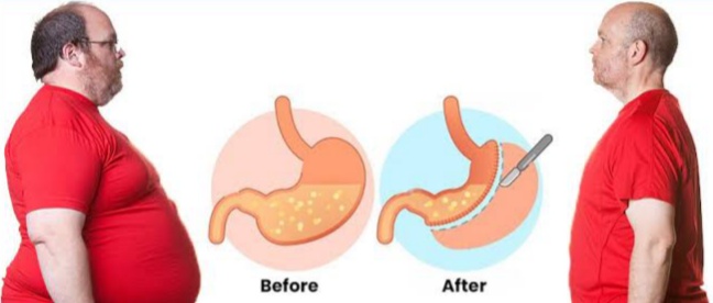 Image Risks and Considerations of Weight Loss Surgery Are Highly Prioritized