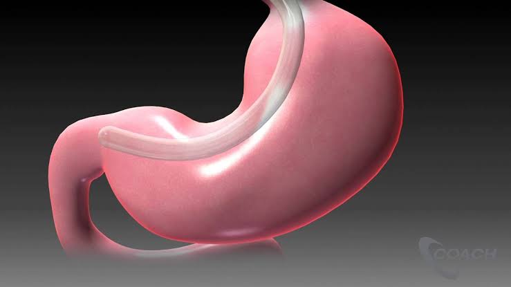 Image Sleeve Gastrectomy Treatment for the Long Term