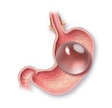 Image Allurion Gastric Balloon A Revolutionary Approach to Weight Loss