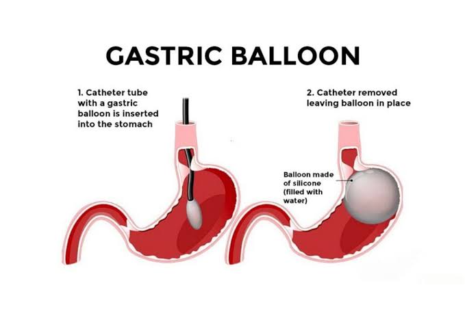 Image The Future of Gastric Balloons A Promising Path in Weight Management