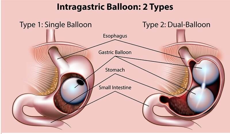 Image Intragastric Balloon A Non Surgical Option for Weight Loss