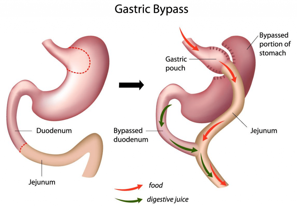 Image Gastric Bypass Surgery An Overview