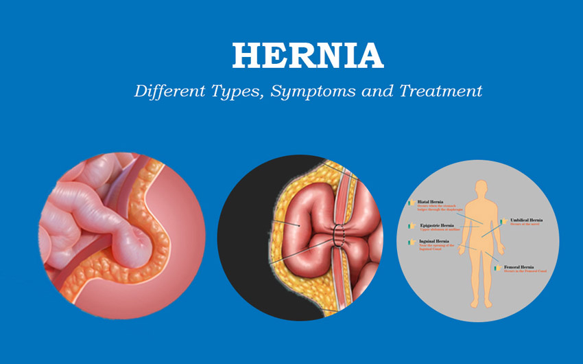 Image Inguinal Hernia Symptoms, and Treatment