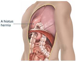 Image Hiatus Hernia Surgery in Perth The Best Choice to Maintain Your Body Health