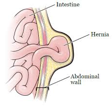 Image Incisional Hernia Recovery A Vital Step for Body Health