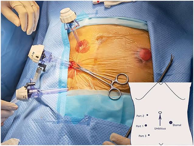 Image Laparoscopic Hernia Repair Can Restore Your Body's Health