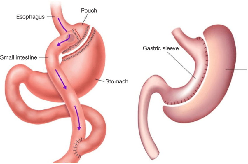 Image Weight Regain After Bariatric Surgery