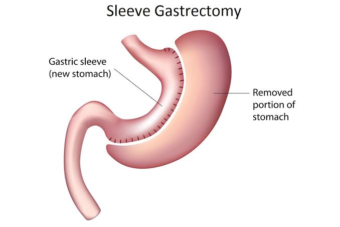 Weight Regain After Sleeve Gastrectomy Causes, Management, and Prevention Image Weight Regain After Sleeve Gastrectomy Causes, Management, and Prevention