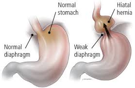 Image What Causes Hiatus Hernia?