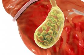 Preventing Gallbladder Problems Image Preventing Gallbladder Problems