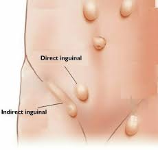 Image The Future of Research for Hernia Prevention