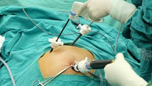 How to Deal with Post-Gallbladder Surgery Problems Image How to Deal with Post-Gallbladder Surgery Problems